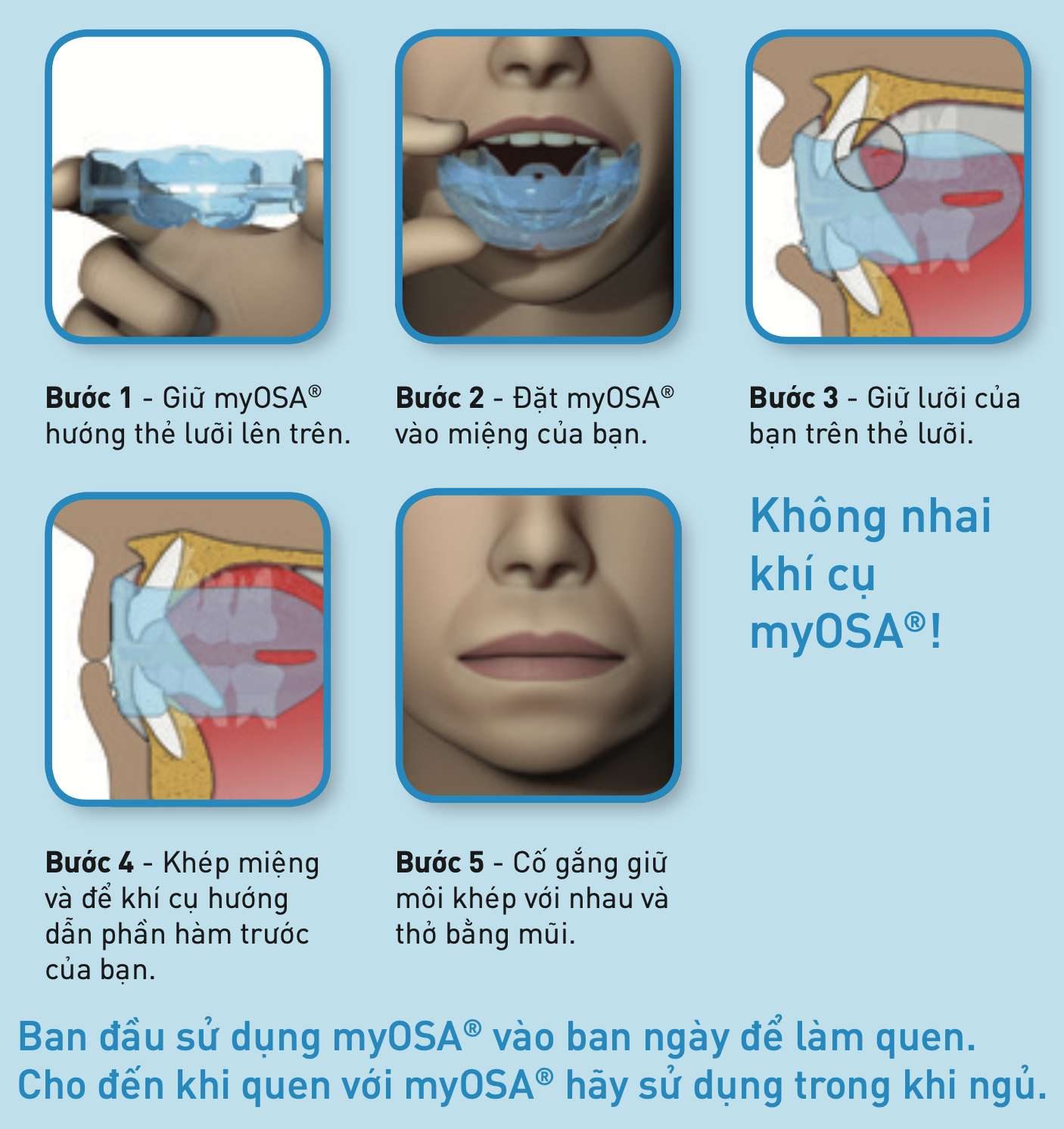 Máng chống ngáy và điều chỉnh đường thở Myosa